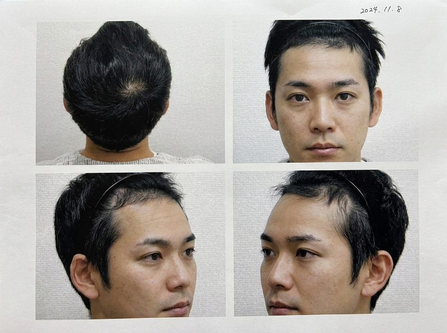 AGA治療経過写真 2024年11月