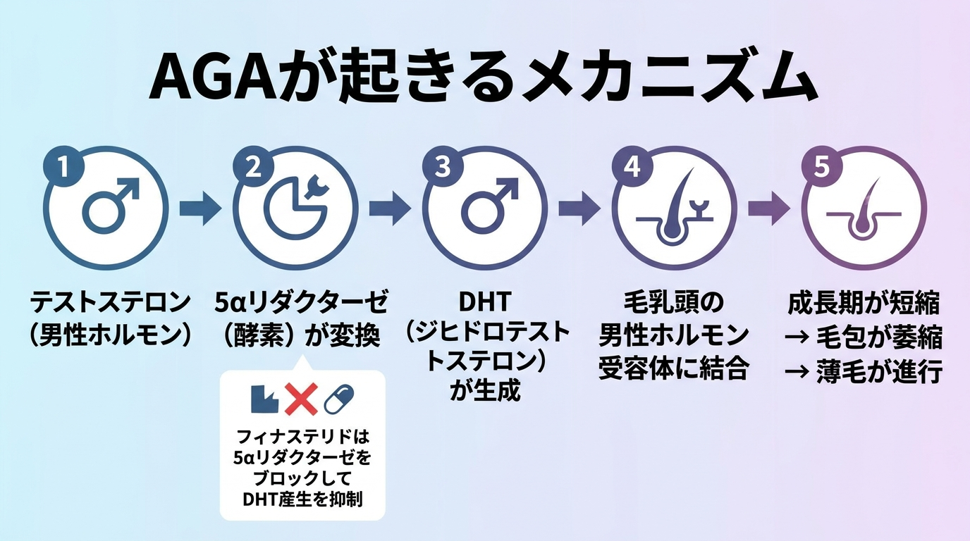 タイトル: AGAが起きるメカニズム。フロー図（左から右）。ステップ1: テストステロン（男性ホルモン）。矢印。ステップ2: 5αリダクターゼ（酵素）が変換。矢印。ステップ3: DHT（ジヒドロテストステロン）が生成。矢印。ステップ4: 毛乳頭の男性ホルモン受容体に結合。矢印。ステップ5: 成長期が短縮 → 毛包が萎縮 → 薄毛が進行。下部に補足: フィナステリドは5αリダクターゼをブロックしてDHT産生を抑制