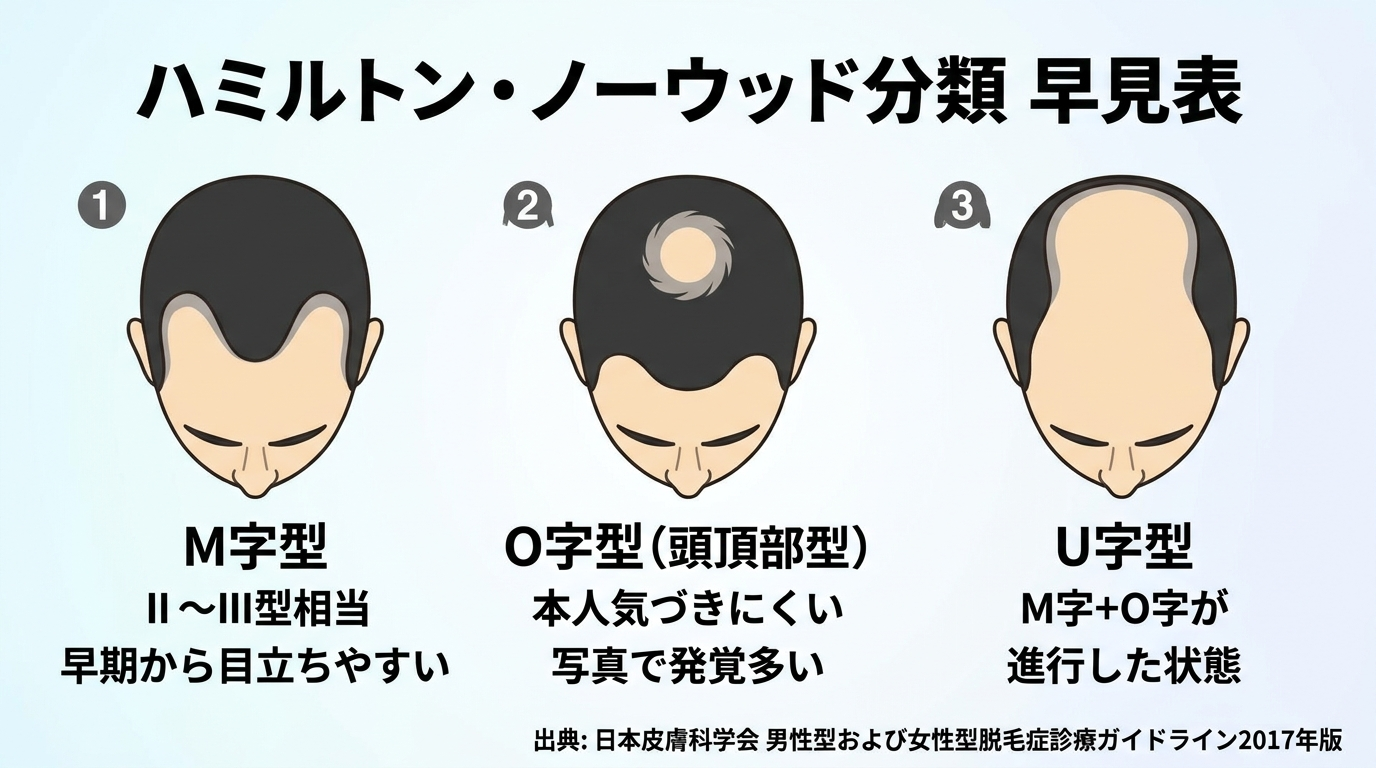 タイトル: ハミルトン・ノーウッド分類 早見表。3つのパターンを横並びで図示: パターン1(M字型): 頭部の上面図で、額の両端(生え際の角)が後退している図。ラベル: M字型 / II〜III型相当 / 早期から目立ちやすい。パターン2(O字型): 頭部の上面図で、頭頂部(つむじ周辺)が円形に薄くなっている図。ラベル: O字型(頭頂部型)/ 本人気づきにくい / 写真で発覚多い。パターン3(U字型): 頭部の上面図で、前頭部〜頭頂部が広く薄くなり後頭部・側頭部のみ髪が残る図。ラベル: U字型 / M字+O字が進行した状態。下部に注記: 出典: 日本皮膚科学会 男性型および女性型脱毛症診療ガイドライン2017年版