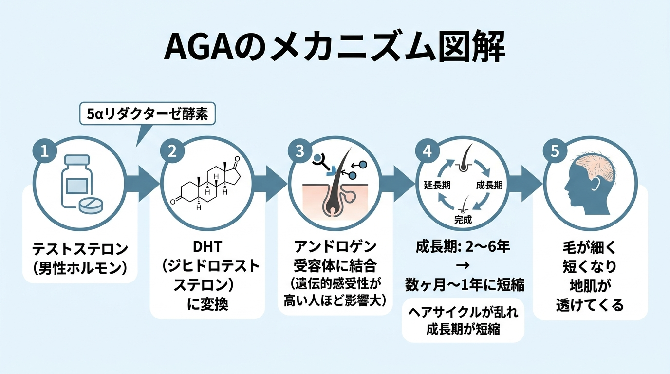 タイトル: AGAのメカニズム図解。左から右へのフロー図。ステップ1（錠剤アイコン）: テストステロン（男性ホルモン）。矢印（5αリダクターゼ酵素）。ステップ2（化学式アイコン）: DHT（ジヒドロテストステロン）に変換。矢印。ステップ3（毛根アイコン）: アンドロゲン受容体に結合（遺伝的感受性が高い人ほど影響大）。矢印。ステップ4（ヘアサイクル図）: ヘアサイクルが乱れ成長期が2〜6年→数ヶ月〜1年に短縮。矢印。ステップ5（薄毛シルエット）: 毛が細く短くなり地肌が透けてくる