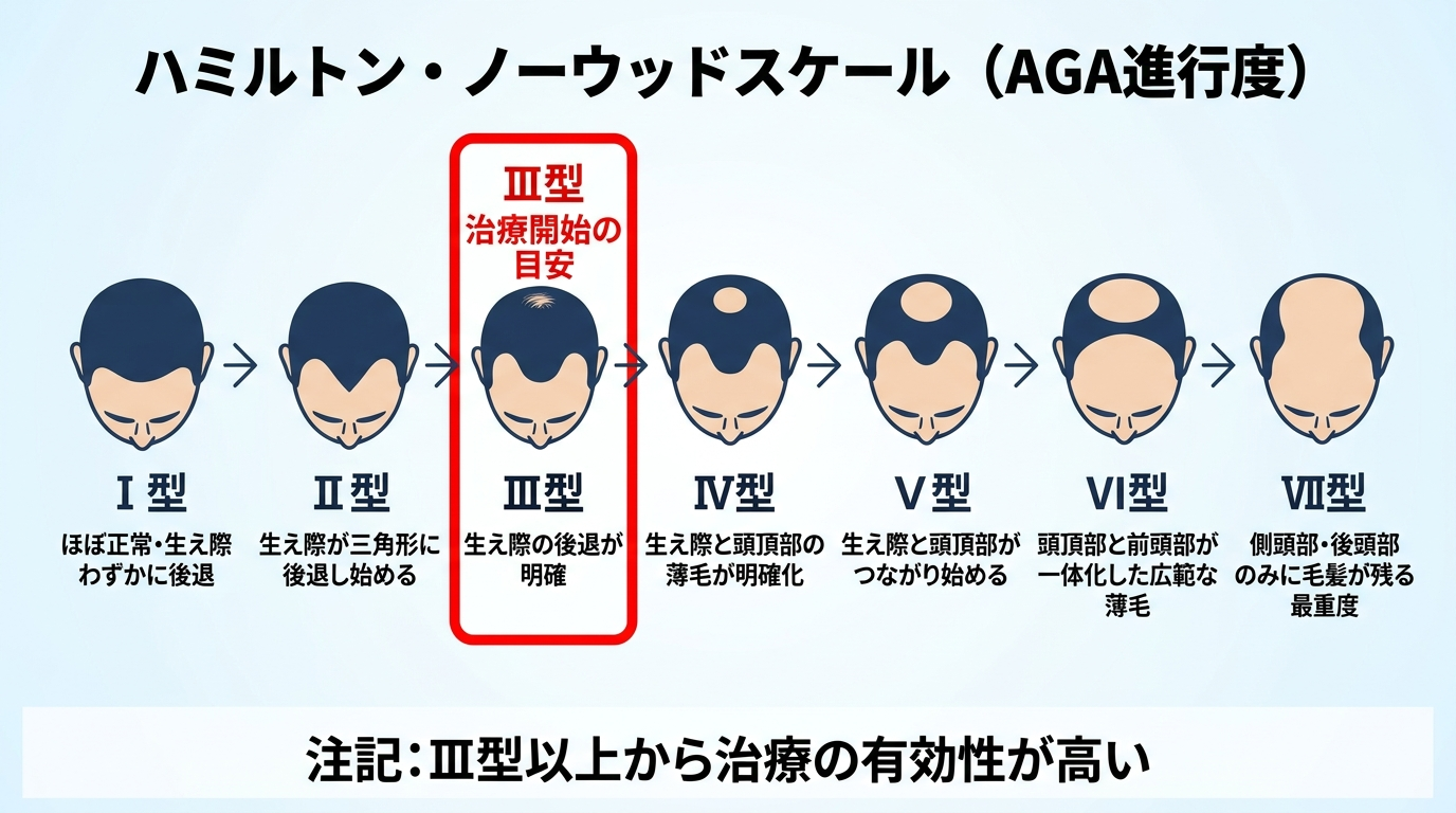 タイトル: ハミルトン・ノーウッドスケール（AGA進行度）。7段階の頭部上面シルエット図。Ⅰ型: ほぼ正常・生え際わずかに後退。Ⅱ型: 生え際が三角形に後退し始める。Ⅲ型: 生え際の後退が明確（治療開始の目安、赤枠で強調）。Ⅳ型: 生え際と頭頂部の薄毛が明確化。Ⅴ型: 生え際と頭頂部がつながり始める。Ⅵ型: 頭頂部と前頭部が一体化した広範な薄毛。Ⅶ型: 側頭部・後頭部のみに毛髪が残る最重度。下部に注記: Ⅲ型以上から治療の有効性が高い