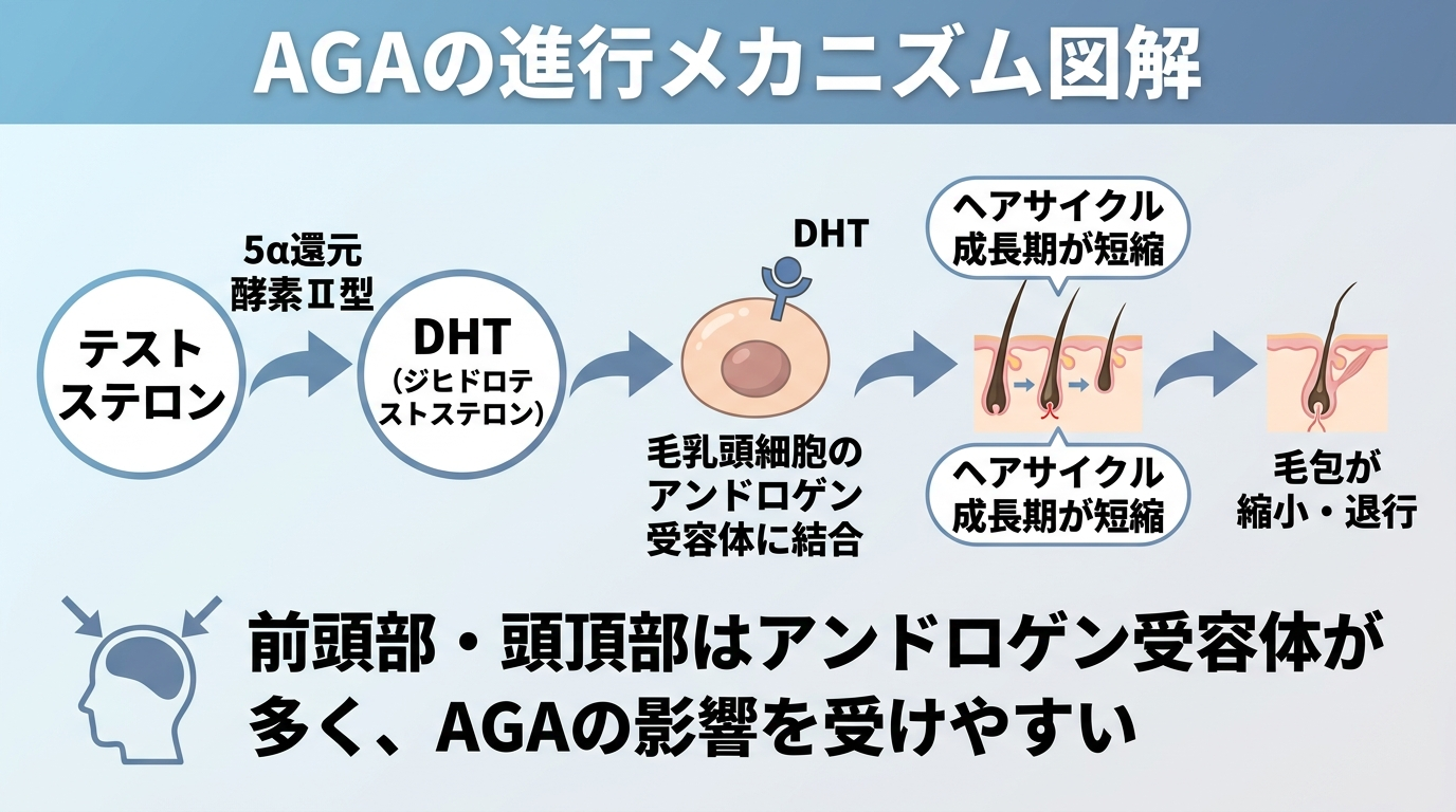タイトル: AGAの進行メカニズム図解。左から右へ矢印でフロー: テストステロン →(5α還元酵素Ⅱ型)→ DHT(ジヒドロテストステロン)→ 毛乳頭細胞のアンドロゲン受容体に結合 → ヘアサイクル成長期が短縮 → 毛包が縮小・退行。下部注釈: 前頭部・頭頂部はアンドロゲン受容体が多く、AGAの影響を受けやすい