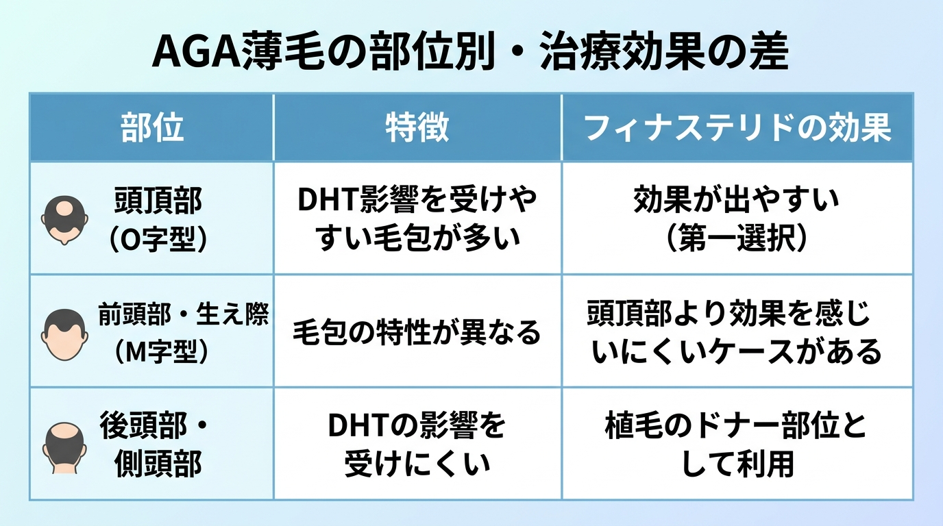タイトル: AGA薄毛の部位別・治療効果の差。2列の比較表。ヘッダー行: 部位 | 特徴 | フィナステリドの効果。行1: 頭頂部（O字型） | DHT影響を受けやすい毛包が多い | 効果が出やすいとされる（第一選択薬）。行2: 前頭部・生え際（M字型） | 毛包の特性が異なる | 頭頂部より効果を感じにくいケースがある。行3: 後頭部・側頭部 | DHTの影響を受けにくい | 植毛のドナー部位として利用