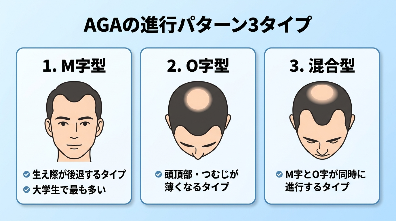 タイトル: AGAの進行パターン3タイプ。横並び3カードで: カード1(前頭部のイラスト)ヘッダー: M字型、説明: 生え際が後退するタイプ。大学生で最も多い。カード2(頭頂部のイラスト)ヘッダー: O字型、説明: 頭頂部・つむじが薄くなるタイプ。カード3(前頭部+頭頂部のイラスト)ヘッダー: 混合型、説明: M字とO字が同時に進行するタイプ
