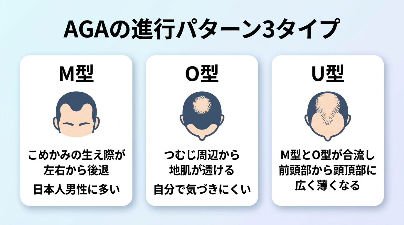 タイトル: AGAの進行パターン3タイプ。横並び3カードで: カード1（前頭部のアイコン）ヘッダー: M型、説明: こめかみの生え際が左右から後退。日本人男性に多い。カード2（頭頂部のアイコン）ヘッダー: O型、説明: つむじ周辺から地肌が透ける。自分で気づきにくい。カード3（広範囲のアイコン）ヘッダー: U型、説明: M型とO型が合流し前頭部から頭頂部に広く薄くなる