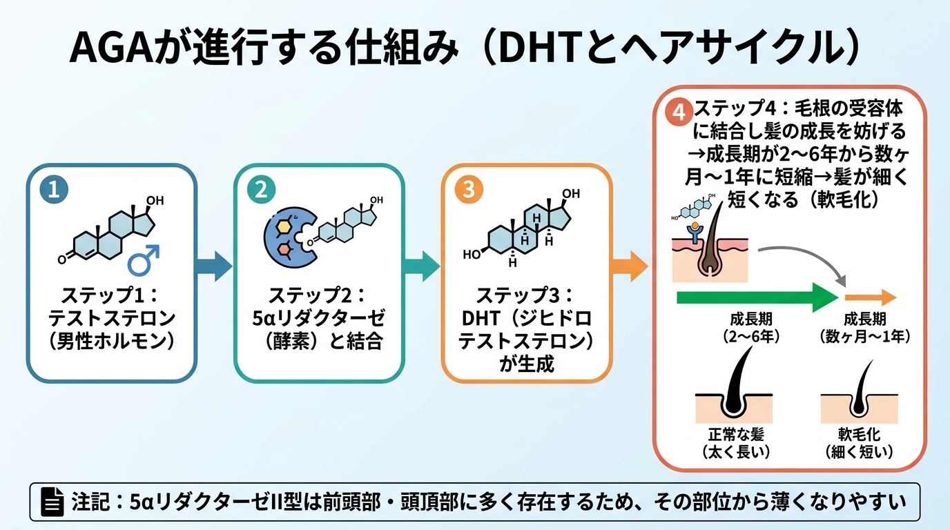 タイトル: AGAが進行する仕組み(DHTとヘアサイクル)。フロー図で左から右へ4ステップ: ステップ1: テストステロン(男性ホルモン)。ステップ2: 5αリダクターゼ(酵素)と結合。ステップ3: DHT(ジヒドロテストステロン)が生成。ステップ4: 毛根の受容体に結合し髪の成長を妨げる→成長期が2〜6年から数ヶ月〜1年に短縮→髪が細く短くなる(軟毛化)。下部に注記: 5αリダクターゼII型は前頭部・頭頂部に多く存在するため、その部位から薄くなりやすい