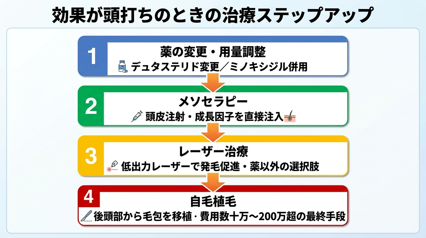 タイトル: 効果が頭打ちのときの治療ステップアップ。4段階の縦フロー図: ステップ1: 薬の変更・用量調整(デュタステリド変更/ミノキシジル併用)。ステップ2: メソセラピー(頭皮注射・成長因子を直接注入)。ステップ3: レーザー治療(低出力レーザーで発毛促進・薬以外の選択肢)。ステップ4: 自毛植毛(後頭部から毛包を移植・費用数十万〜200万円超の最終手段)。矢印で下に向かって進行度が上がることを示す