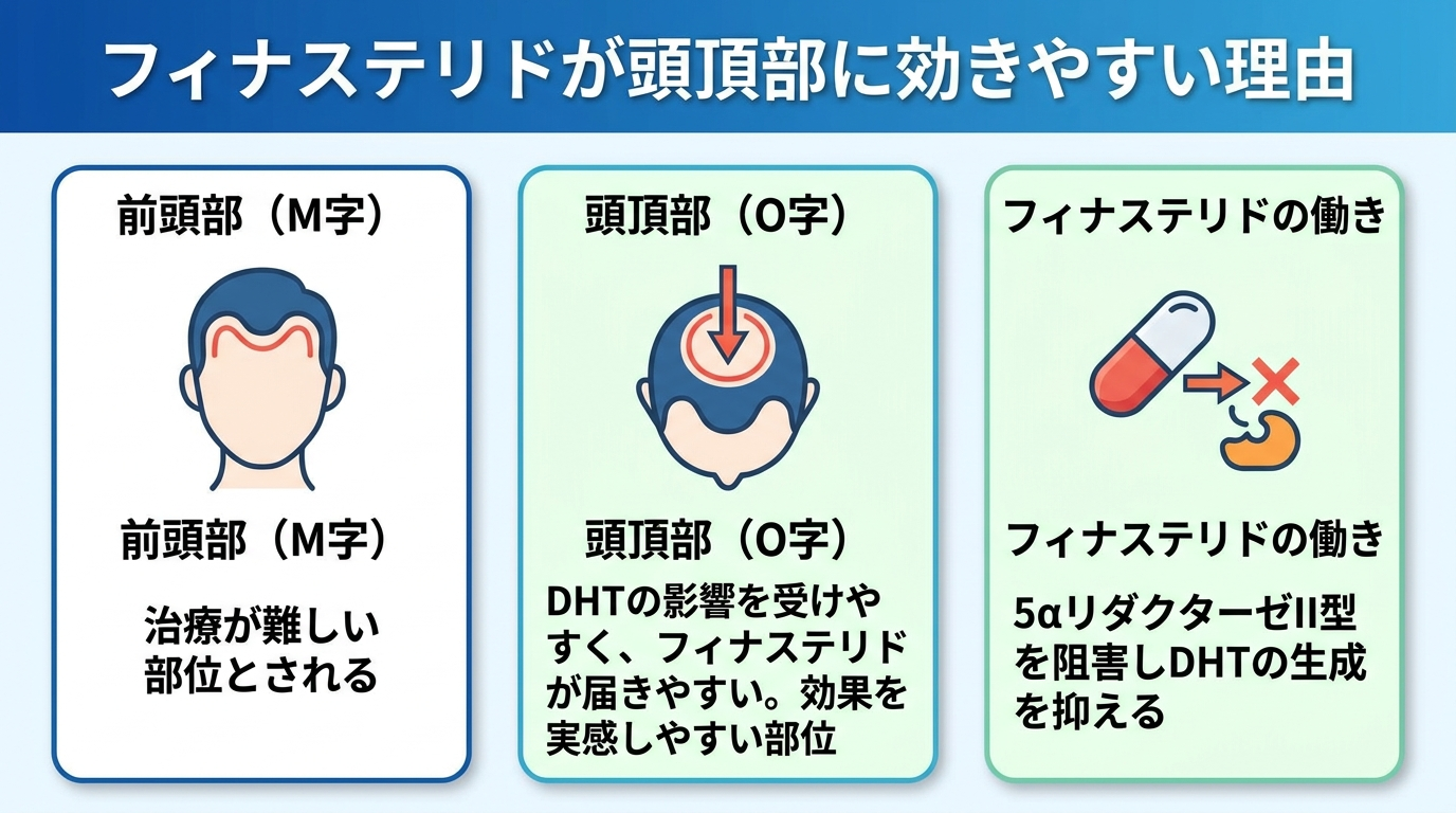 タイトル: フィナステリドが頭頂部に効きやすい理由。横並び3カードで: カード1(頭部前から見たアイコン・生え際)ヘッダー: 前頭部(M字)、説明: 治療が難しい部位とされる。カード2(頭部上から見たアイコン・つむじ)ヘッダー: 頭頂部(O字)、説明: DHTの影響を受けやすく、フィナステリドが届きやすい。効果を実感しやすい部位。カード3(錠剤アイコン)ヘッダー: フィナステリドの働き、説明: 5αリダクターゼII型を阻害しDHTの生成を抑える