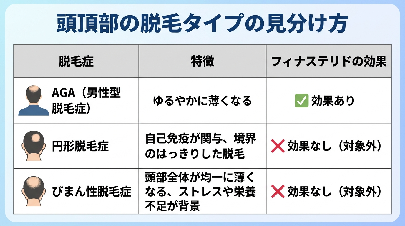 タイトル: 頭頂部の脱毛タイプの見分け方。3列の表: ヘッダー行: 脱毛症 | 特徴 | フィナステリドの効果。行1: AGA(男性型脱毛症) | ゆるやかに薄くなる | 効果あり。行2: 円形脱毛症 | 自己免疫が関与、境界のはっきりした脱毛 | 効果なし(対象外)。行3: びまん性脱毛症 | 頭部全体が均一に薄くなる、ストレスや栄養不足が背景 | 効果なし(対象外)