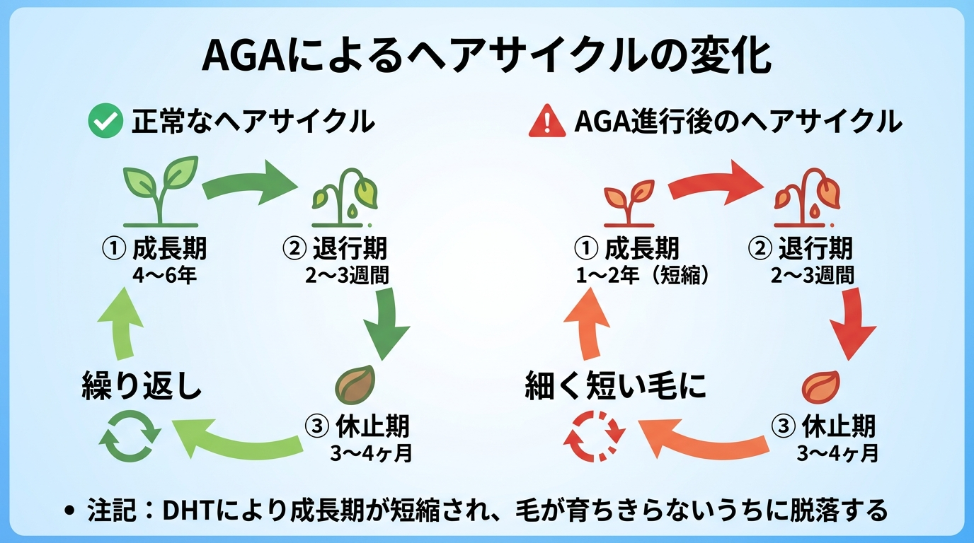 タイトル: AGAによるヘアサイクルの変化。横2列比較図: 左列(正常): 成長期4〜6年 → 退行期2〜3週間 → 休止期3〜4ヶ月 → 繰り返し。右列(AGA進行後): 成長期1〜2年(短縮) → 退行期2〜3週間 → 休止期3〜4ヶ月 → 細く短い毛に。下部注記: DHTにより成長期が短縮され、毛が育ちきらないうちに脱落する
