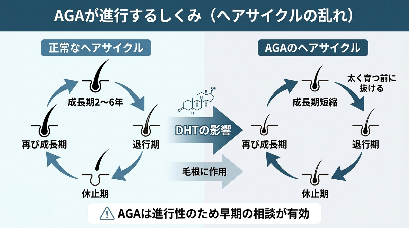 タイトル: AGAが進行するしくみ（ヘアサイクルの乱れ）。左に正常なヘアサイクルの図: 成長期2〜6年→退行期→休止期→再び成長期。右にAGAのヘアサイクルの図: DHTの影響で成長期が短縮し、太く育つ前に抜ける。中央にDHTが毛根に作用する矢印。下部注記: AGAは進行性のため早期の相談が有効