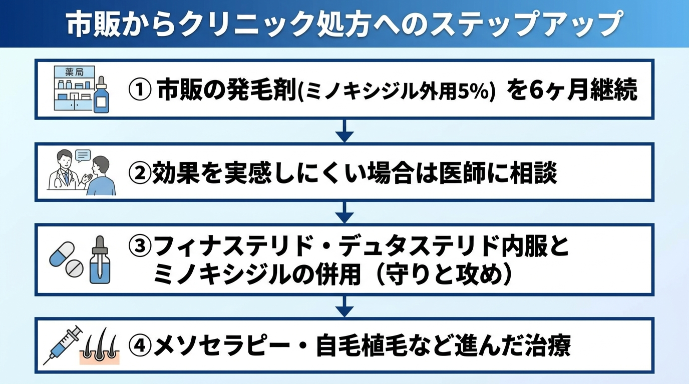 タイトル: 市販からクリニック処方へのステップアップ。縦フロー図で4段階: 段階1 市販の発毛剤(ミノキシジル外用5%)を6ヶ月継続。段階2 効果を実感しにくい場合は医師に相談。段階3 フィナステリド・デュタステリド内服とミノキシジルの併用(守りと攻め)。段階4 メソセラピー・自毛植毛など進んだ治療