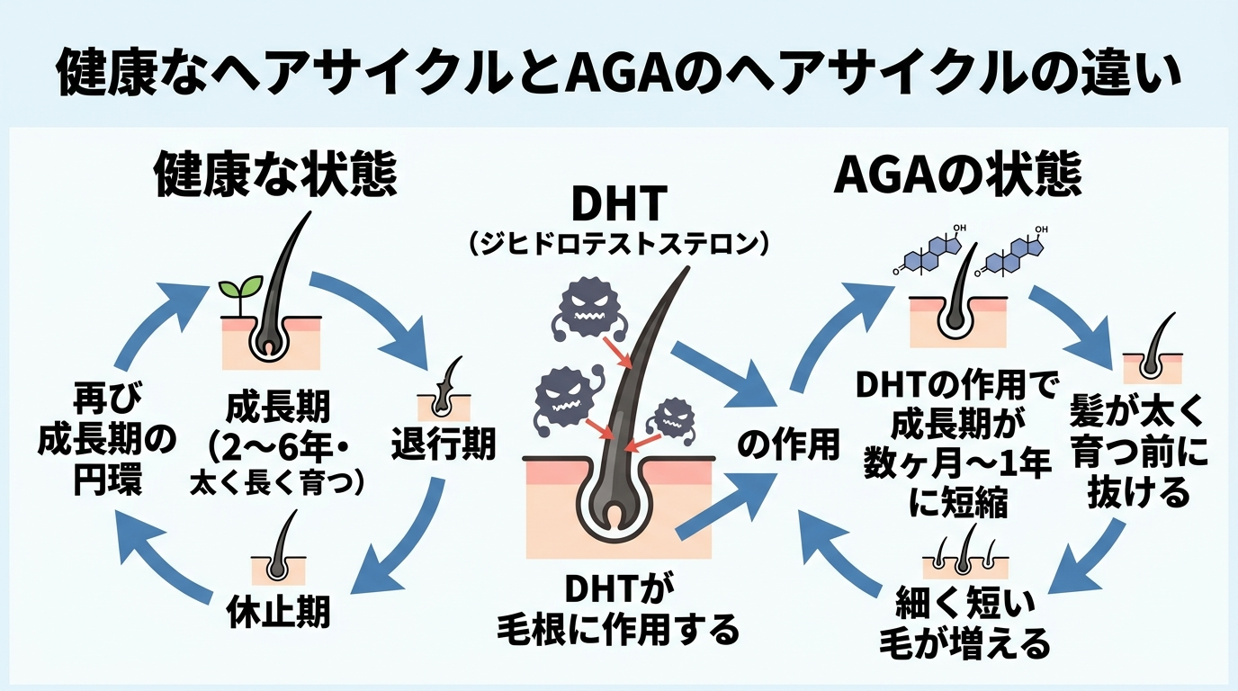 タイトル: 健康なヘアサイクルとAGAのヘアサイクルの違い。左右2列の比較図: 左（健康な状態）成長期（2〜6年・太く長く育つ）→退行期→休止期→再び成長期の円環。右（AGAの状態）DHTの作用で成長期が数ヶ月〜1年に短縮→髪が太く育つ前に抜ける→細く短い毛が増える。中央にDHT（ジヒドロテストステロン）が毛根に作用するイラスト