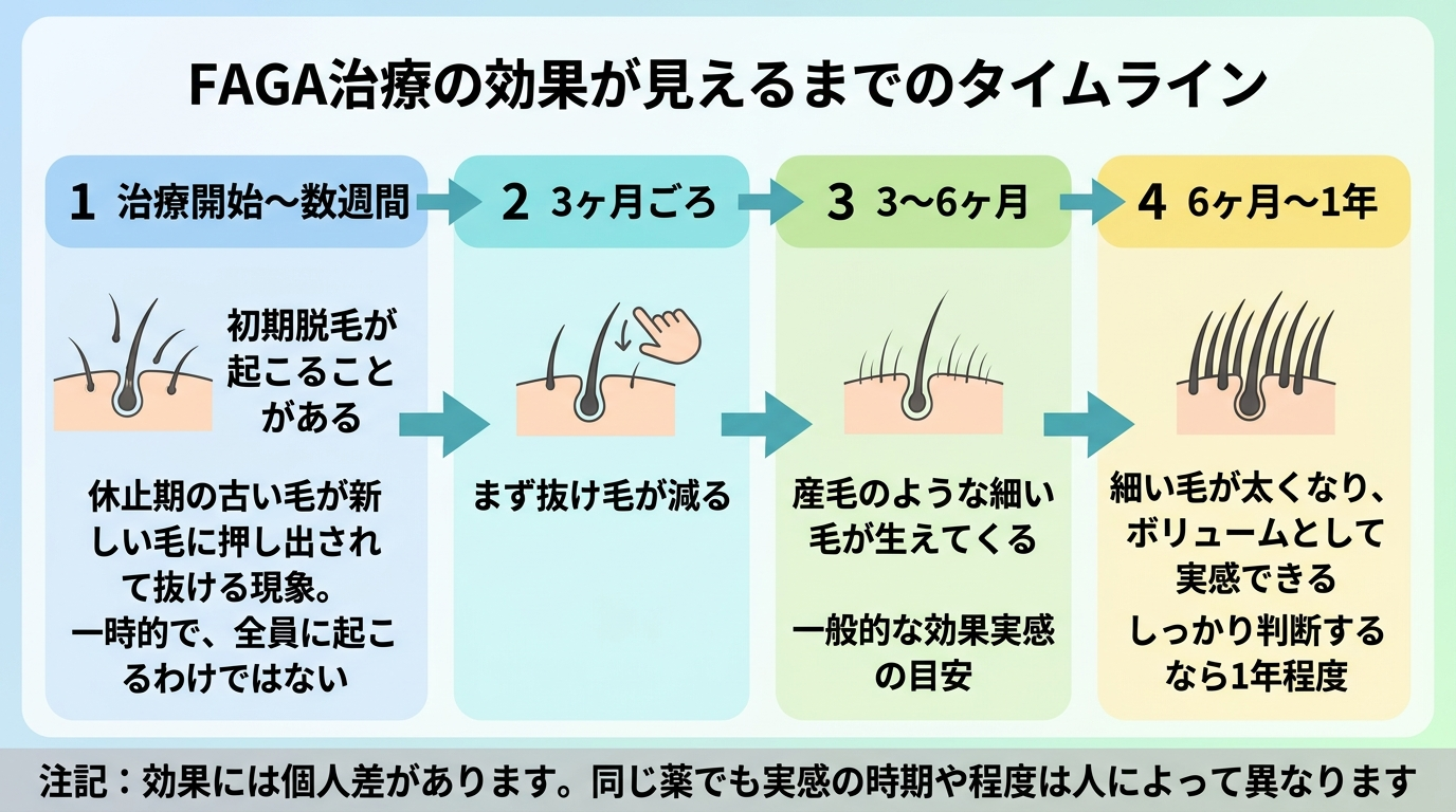 タイトル: FAGA治療の効果が見えるまでのタイムライン。横方向の時系列フロー図(4ステップ): ステップ1「治療開始〜数週間」: 初期脱毛が起こることがある(休止期の古い毛が新しい毛に押し出されて抜ける現象。一時的で、全員に起こるわけではない)。ステップ2「3ヶ月ごろ」: まず抜け毛が減る。ステップ3「3〜6ヶ月」: 産毛のような細い毛が生えてくる。一般的な効果実感の目安。ステップ4「6ヶ月〜1年」: 細い毛が太くなり、ボリュームとして実感できる。しっかり判断するなら1年程度。下部注記: 効果には個人差があります。同じ薬でも実感の時期や程度は人によって異なります
