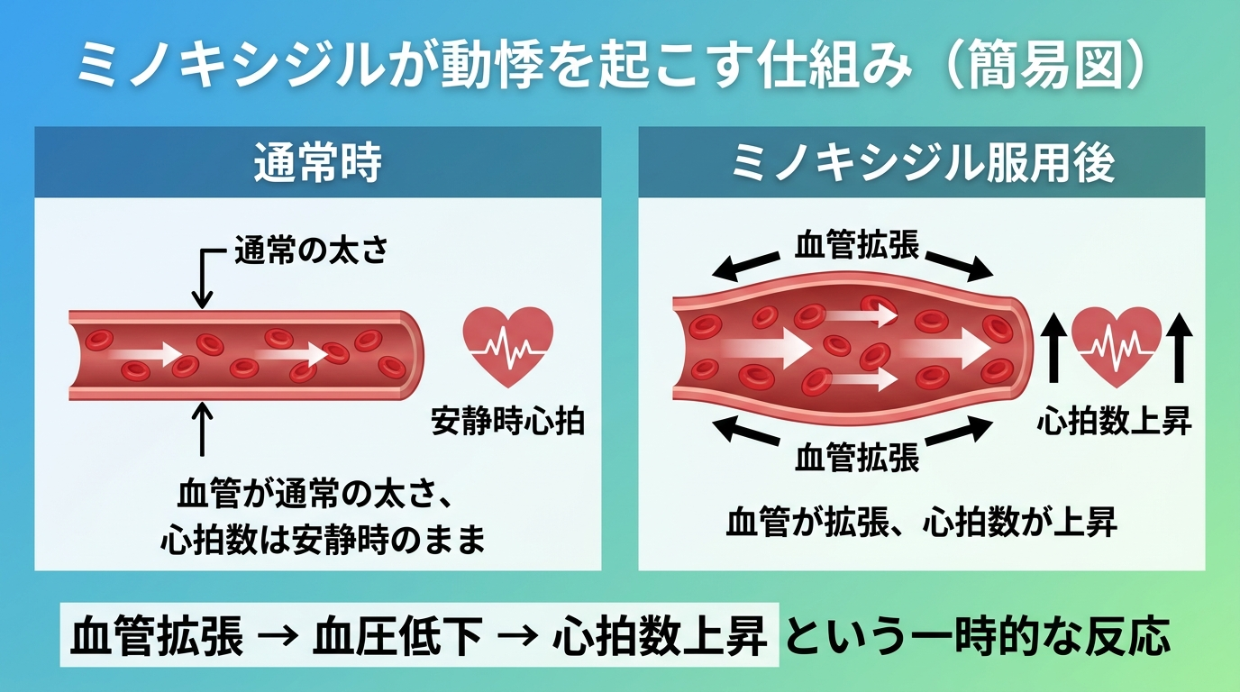 タイトル: ミノキシジルが動悸を起こす仕組み(簡易図)。横並び2パネル比較。パネル1見出し: 通常時、内容: 血管が通常の太さ、心拍数は安静時のまま。パネル2見出し: ミノキシジル服用後、内容: 血管が拡張(矢印で広がりを表現)、心拍数が上昇(ハートアイコンに上向き矢印)。パネル下部に注記テキスト: 血管拡張→血圧低下→心拍数上昇という一時的な反応