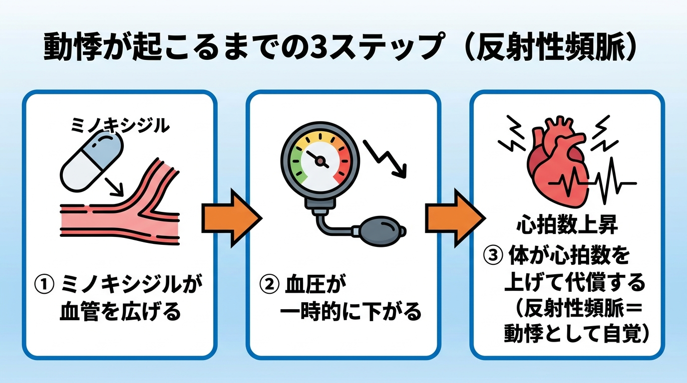 タイトル: 動悸が起こるまでの3ステップ(反射性頻脈)。横一列のフロー図、矢印でつなぐ3ステップ。ステップ1: ミノキシジルが血管を広げる。ステップ2: 血圧が一時的に下がる。ステップ3: 体が心拍数を上げて代償する(反射性頻脈=動悸として自覚)