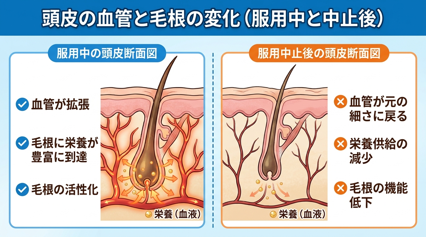 頭皮の血管と毛根のイラスト。左: 服用中の頭皮断面図で血管が拡張し毛根に栄養が届いている様子。右: 服用中止後の頭皮断面図で血管が元の太さに戻り栄養供給が減っている様子。