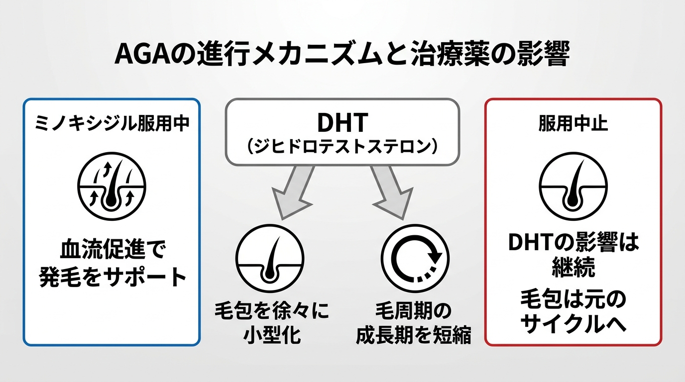 AGAの進行メカニズムを示す図。中央に「DHT(ジヒドロテストステロン)」、矢印で「毛包を徐々に小型化」「毛周期の成長期を短縮」と表示。左側に「ミノキシジル服用中: 血流促進で発毛をサポート」、右側に「服用中止: DHTの影響は継続、毛包は元のサイクルへ」の対比枠。