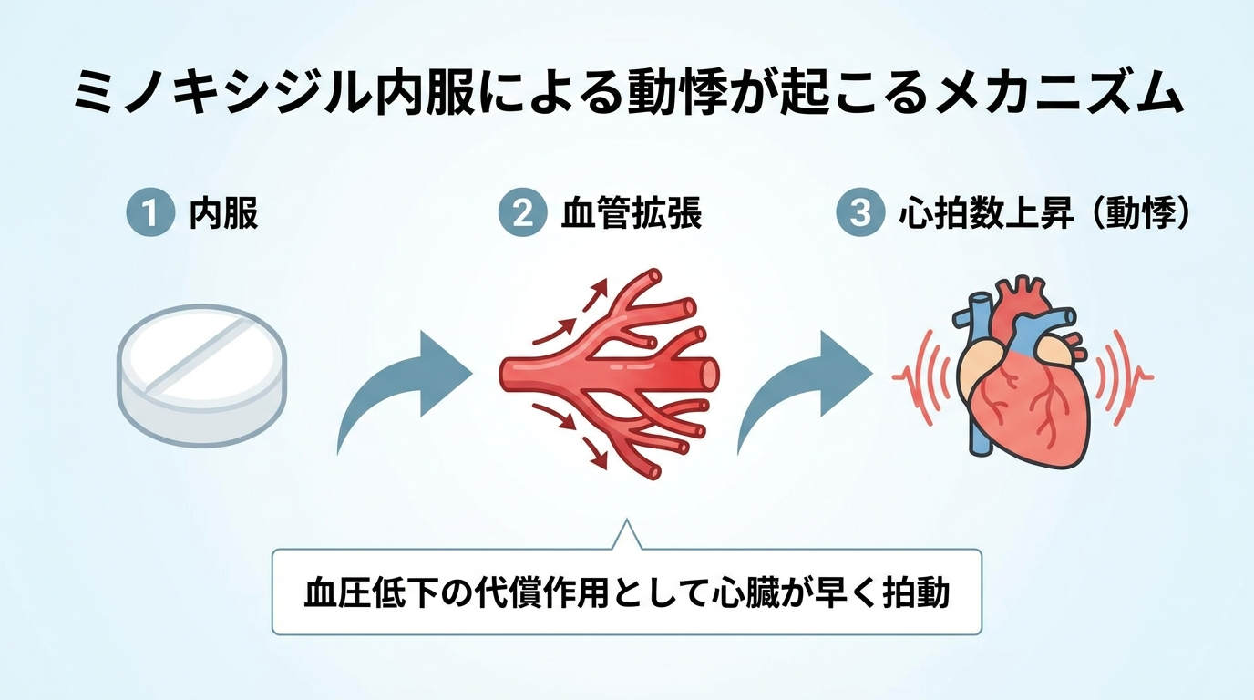 タイトル: ミノキシジル内服による動悸が起こるメカニズム。3ステップのイラストフロー図。ステップ1(錠剤アイコン): 内服。ステップ2(広がる血管アイコン): 血管拡張。ステップ3(心臓と脈波アイコン): 心拍数上昇(動悸)。矢印でステップ1→2→3を接続。