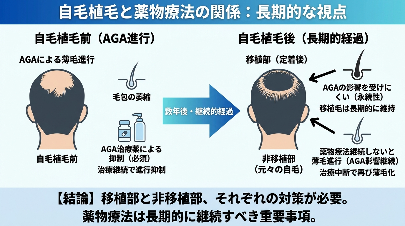 自毛植毛と薬物療法の関係を示す図解。ビフォーアフター概念図で移植部と非移植部を対比: 移植部は定着後もAGAの影響を受けにくい一方、周囲の非移植部は薬物治療を継続しないと薄毛が進行しうることを示す。