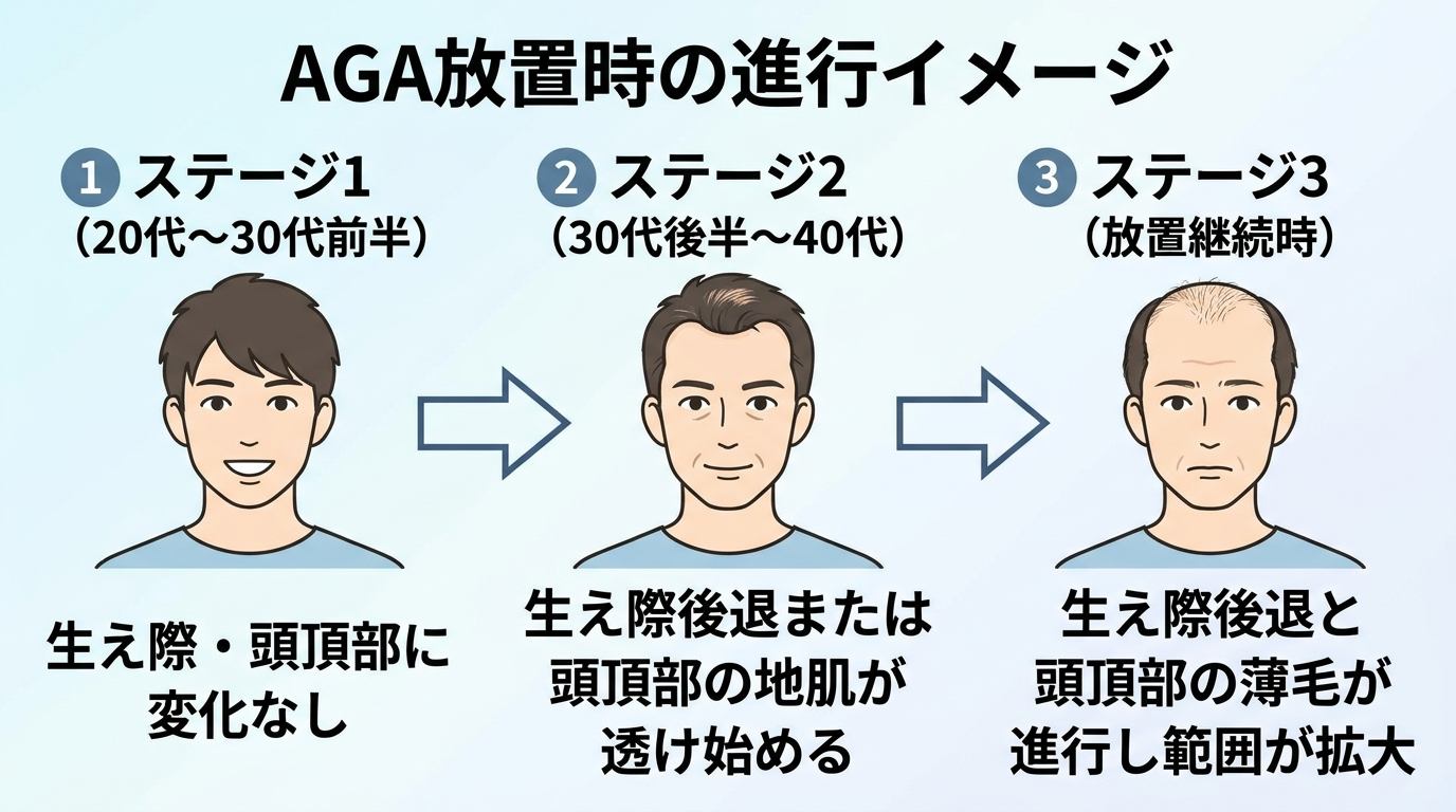 タイトル: AGA放置時の進行イメージ。横に並ぶ3段階のイラスト: ステージ1(20代〜30代前半)生え際・頭頂部に変化なし。ステージ2(30代後半〜40代)生え際後退または頭頂部の地肌が透け始める。ステージ3(放置継続時)生え際後退と頭頂部の薄毛が進行し範囲が拡大。各ステージを矢印でつなぐ進行フロー図。