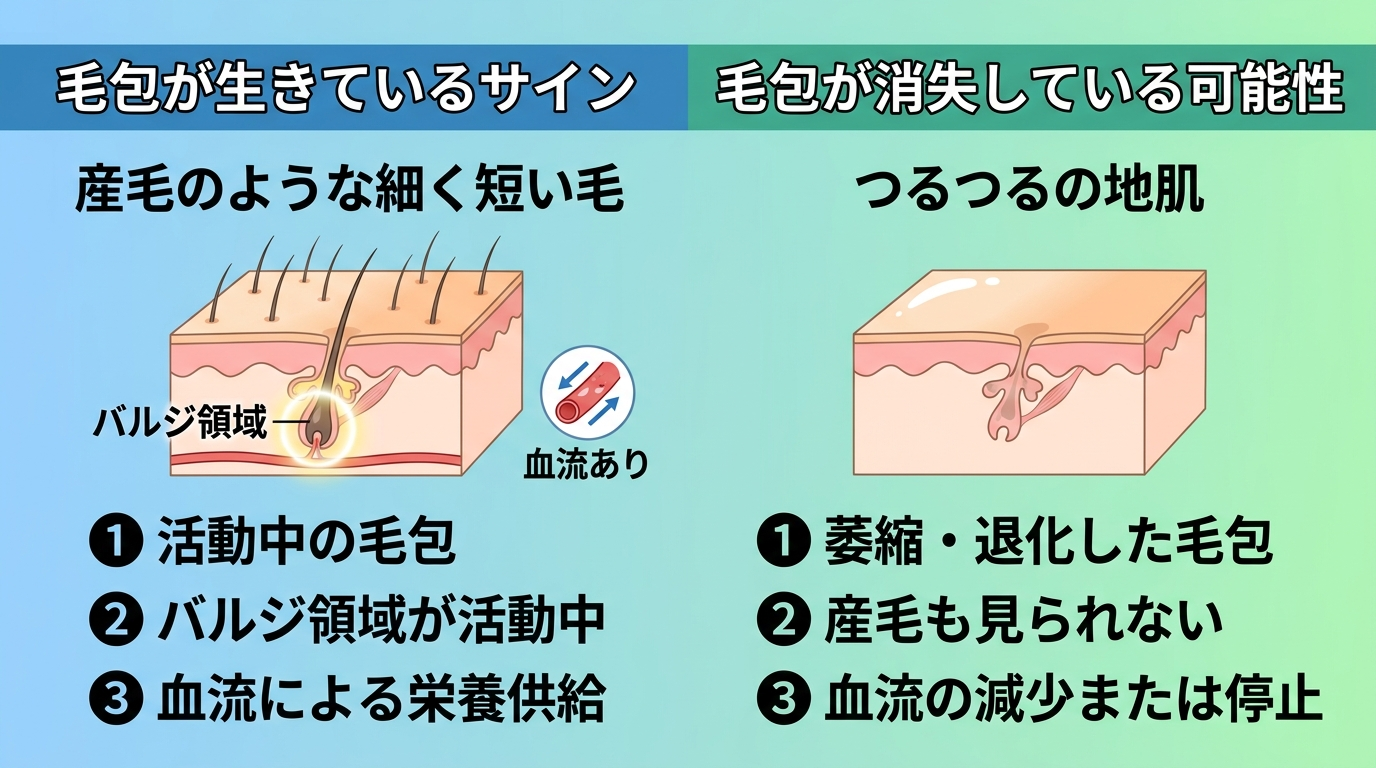 毛包の状態を見極めるイラスト。左側: 頭皮断面図『毛包が生きているサイン』産毛のような細く短い毛が生えており、毛包(バルジ領域)が活動中で血流あり。右側: 頭皮断面図『毛包が消失している可能性』つるつるの地肌で毛包が萎縮・退化し、産毛も見られない。
