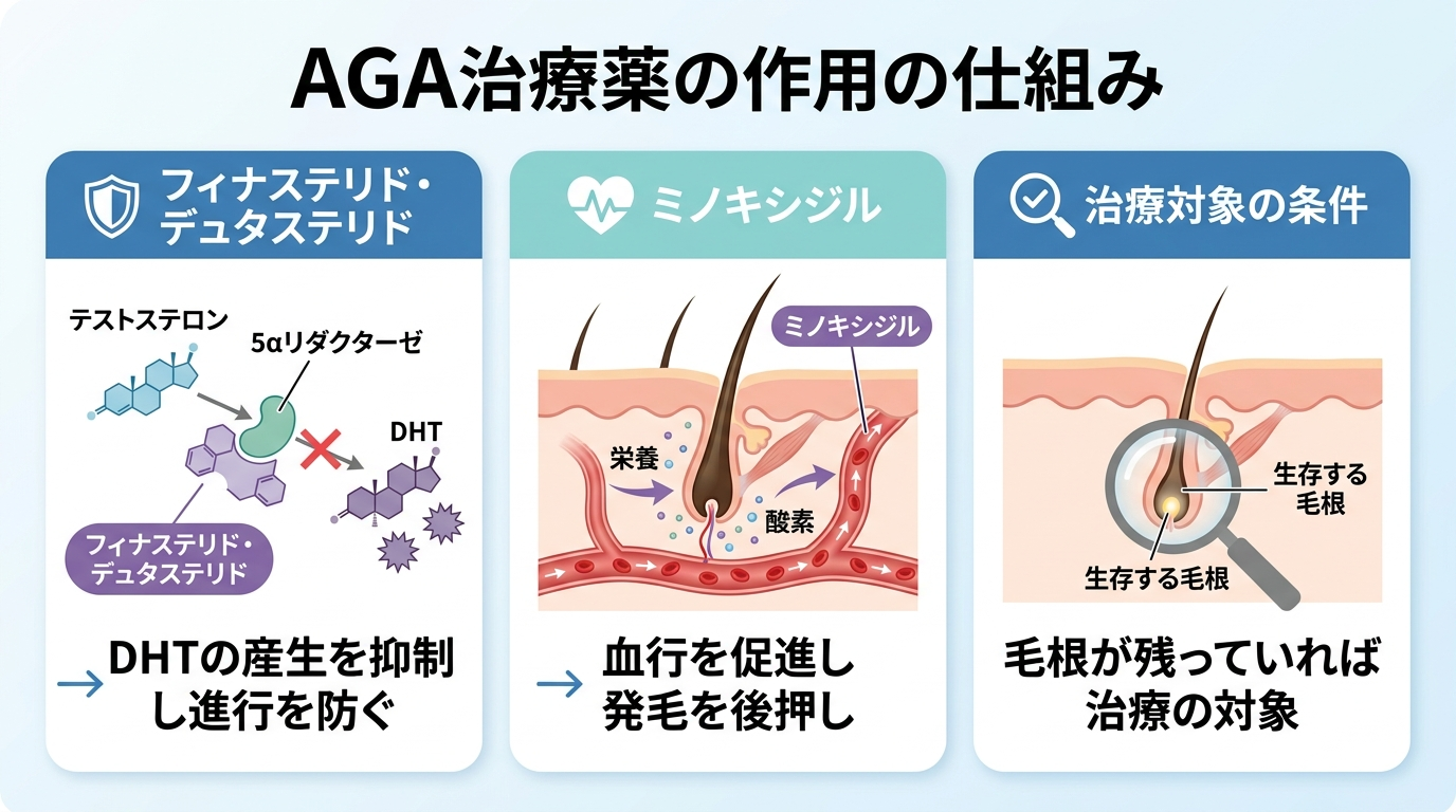 タイトル: AGA治療薬の作用の仕組み。3つのイラストを横並びで: イラスト1(頭皮とDHTのブロックを示す図) ラベル: フィナステリド・デュタステリド → DHTの産生を抑制し進行を防ぐ。イラスト2(血流促進の図) ラベル: ミノキシジル → 血行を促進し発毛を後押し。イラスト3(毛根の断面図) ラベル: 毛根が残っていれば治療の対象