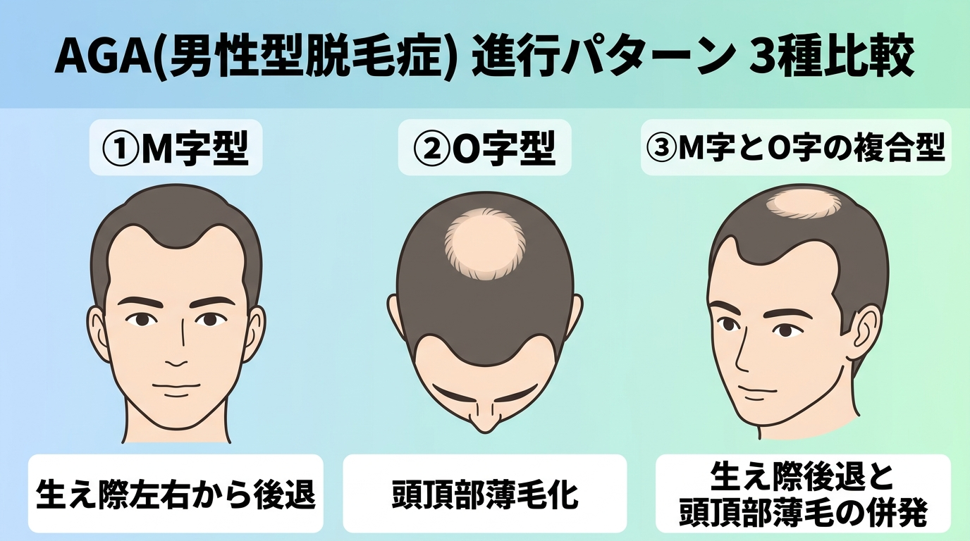AGA(男性型脱毛症)の進行パターンを示す頭部イラスト3種比較。①M字型(生え際が左右から後退)②O字型(頭頂部が薄くなる)③M字とO字の複合型。各タイプの特徴を簡潔なラベルで表示