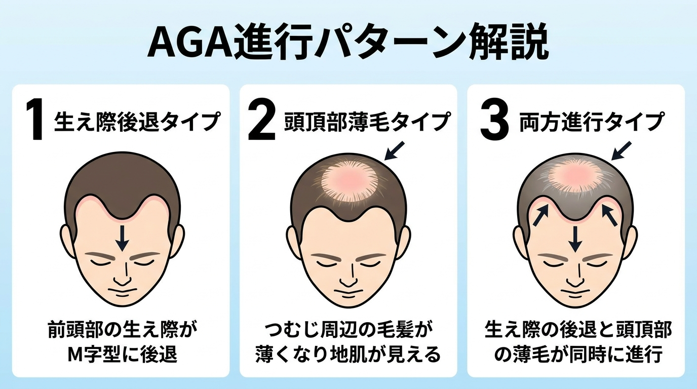 AGAの進行タイプを示す頭部イラスト。3パターンを並べて表示: パターン1「生え際後退タイプ」前頭部のM字型後退を図示、パターン2「頭頂部薄毛タイプ」つむじ周辺のO字型の薄毛を図示、パターン3「両方進行タイプ」生え際と頭頂部の両方が進行した状態を図示。