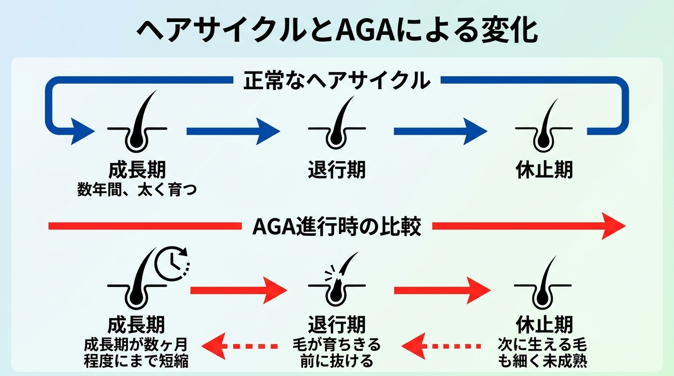 タイトル: ヘアサイクルとAGAによる変化。3段階のフロー図: 成長期(数年間、太く育つ)→退行期→休止期。下段にAGA進行時の比較矢印: 成長期が数ヶ月程度にまで短縮→毛が育ちきる前に抜ける→次に生える毛も細く未成熟。