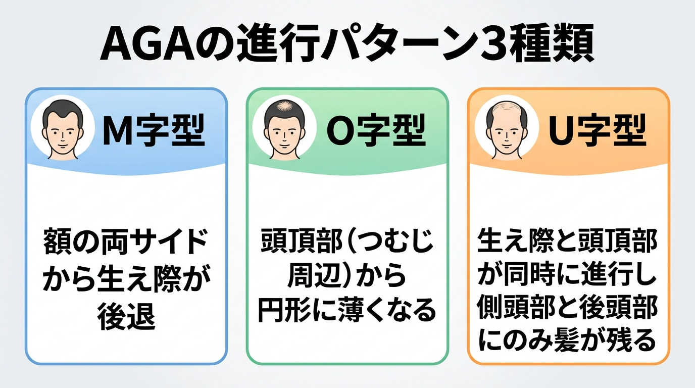 タイトル: AGAの進行パターン3種類。横並び3つのイラスト: イラスト1見出し「M字型」説明「額の両サイドから生え際が後退」。イラスト2見出し「O字型」説明「頭頂部(つむじ周辺)から円形に薄くなる」。イラスト3見出し「U字型」説明「生え際と頭頂部が同時に進行し側頭部と後頭部にのみ髪が残る」。