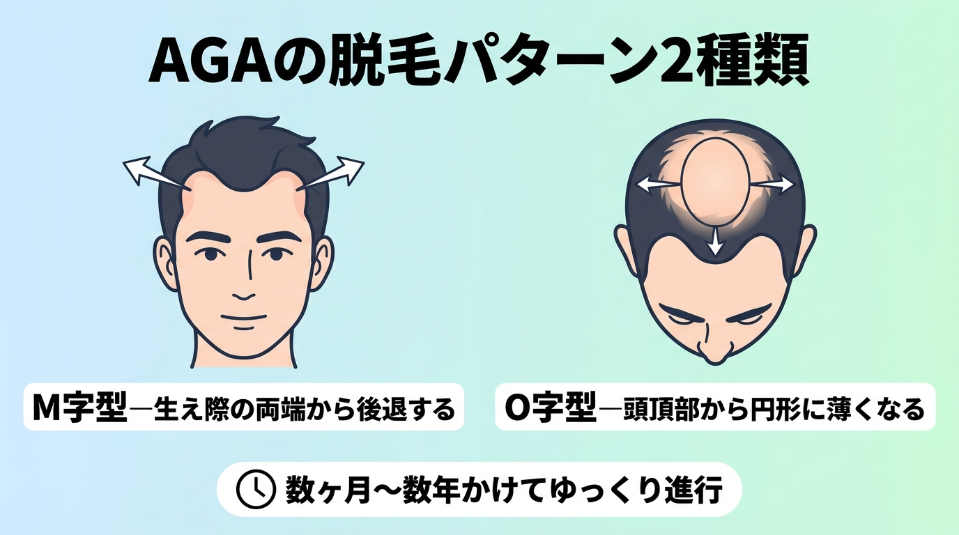 タイトル: AGAの脱毛パターン2種類。左側イラスト: M字型—生え際の両端から後退する図。右側イラスト: O字型—頭頂部から円形に薄くなる図。共通ラベル: 数ヶ月〜数年かけてゆっくり進行。