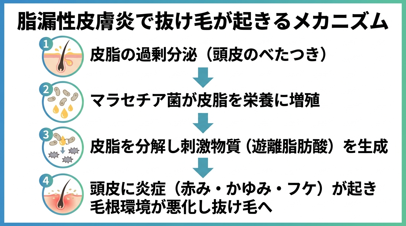 タイトル: 脂漏性皮膚炎で抜け毛が起きるメカニズム。縦フロー図で4ステップ: ステップ1: 皮脂の過剰分泌（頭皮のべたつき）→ ステップ2: マラセチア菌が皮脂を栄養に増殖 → ステップ3: 皮脂を分解し刺激物質（遊離脂肪酸）を生成 → ステップ4: 頭皮に炎症（赤み・かゆみ・フケ）が起き毛根環境が悪化し抜け毛へ