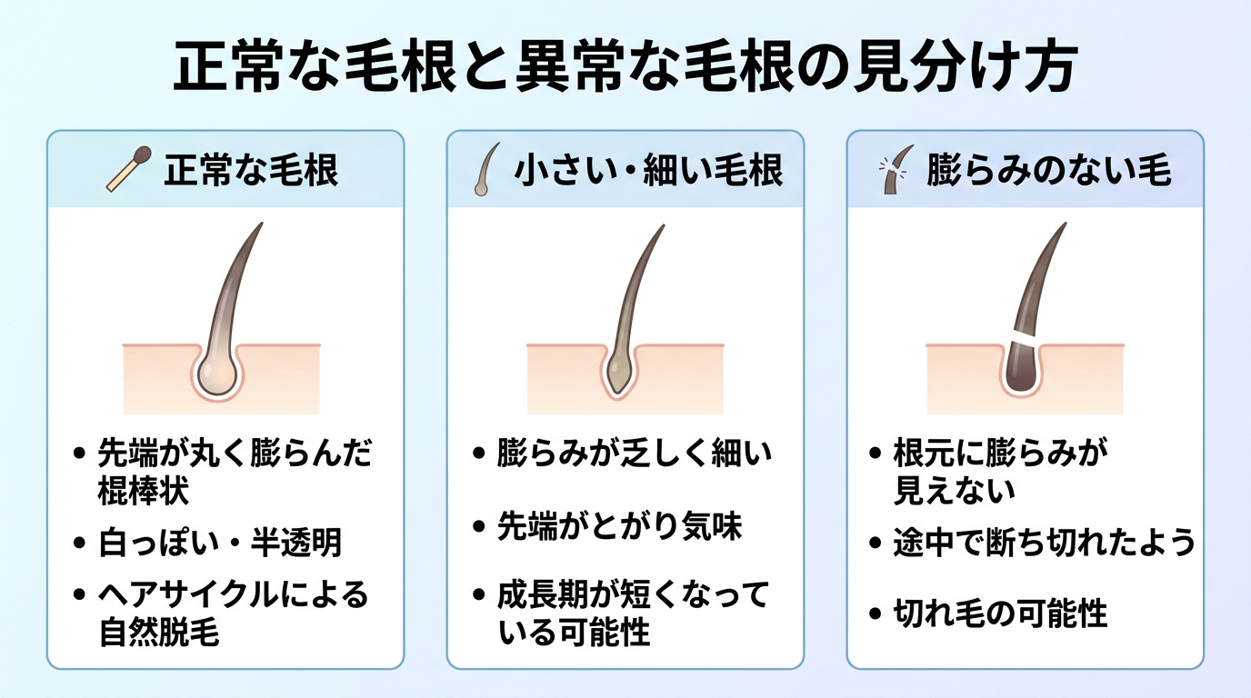 タイトル: 正常な毛根と異常な毛根の見分け方。横並び3カードで比較: カード1(マッチ棒状のアイコン)ヘッダー: 正常な毛根、説明: 先端が丸く膨らんだ棍棒状。白っぽい・半透明。ヘアサイクルによる自然脱毛。カード2(細い毛のアイコン)ヘッダー: 小さい・細い毛根、説明: 膨らみが乏しく細い。先端がとがり気味。成長期が短くなっている可能性。カード3(断ち切れた毛のアイコン)ヘッダー: 膨らみのない毛、説明: 根元に膨らみが見えない。途中で断ち切れたよう。切れ毛の可能性。