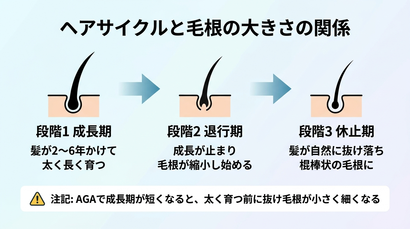 タイトル: ヘアサイクルと毛根の大きさの関係。フロー図で3段階を横に並べる: 段階1(太い髪のアイコン)成長期: 髪が2〜6年かけて太く長く育つ。段階2(抜け始めのアイコン)退行期: 成長が止まり毛根が縮小し始める。段階3(棍棒状毛根のアイコン)休止期: 髪が自然に抜け落ち棍棒状の毛根に。下部に注記: AGAで成長期が短くなると、太く育つ前に抜け毛根が小さく細くなる。