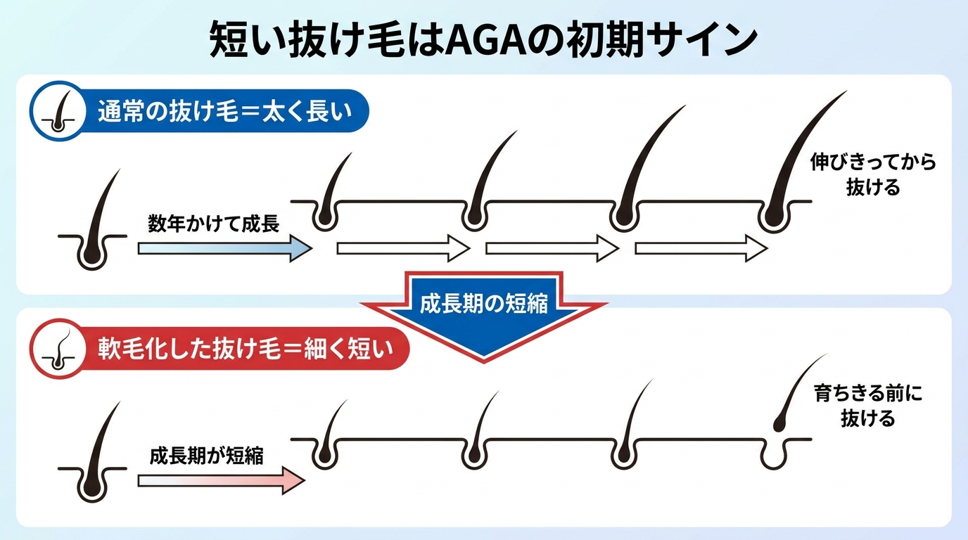 タイトル: 短い抜け毛はAGAの初期サイン。上下2段の対比イラスト。上段(正常): 太く長い毛が数年かけて成長し、伸びきってから抜ける様子。ラベル『通常の抜け毛=太く長い』。下段(AGA・軟毛化): 成長期が短縮し、毛が育ちきる前に細く短いまま抜ける様子。ラベル『軟毛化した抜け毛=細く短い』。中央に矢印で『成長期の短縮』と表記