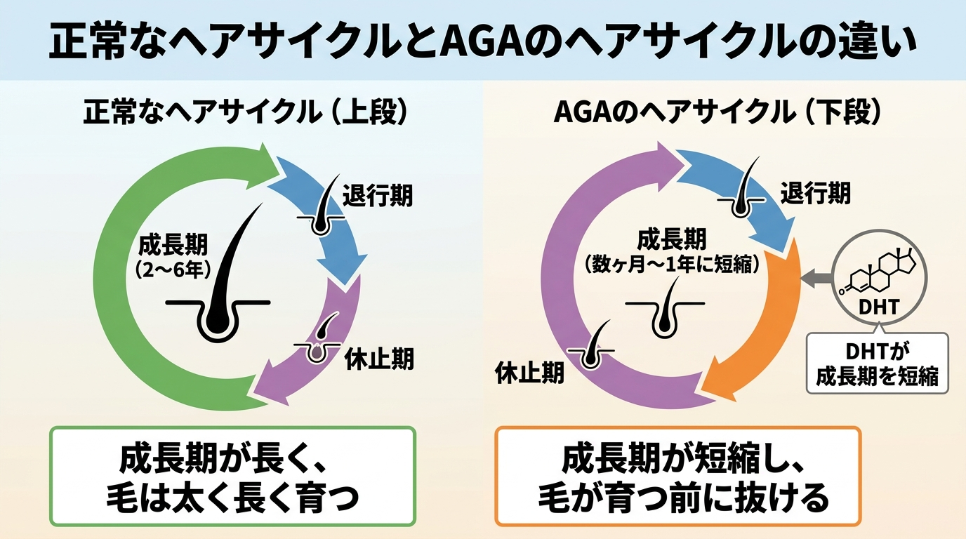 タイトル: 正常なヘアサイクルとAGAのヘアサイクルの違い。上下2段の循環図。上段(正常): 成長期2〜6年 → 退行期 → 休止期 の循環。ラベル『成長期が長く、毛は太く長く育つ』。下段(AGA): 成長期が数ヶ月〜1年に短縮 → 退行期 → 休止期 の循環。ラベル『成長期が短縮し、毛が育つ前に抜ける』。下段にはDHTのアイコンと『DHTが成長期を短縮』の注記
