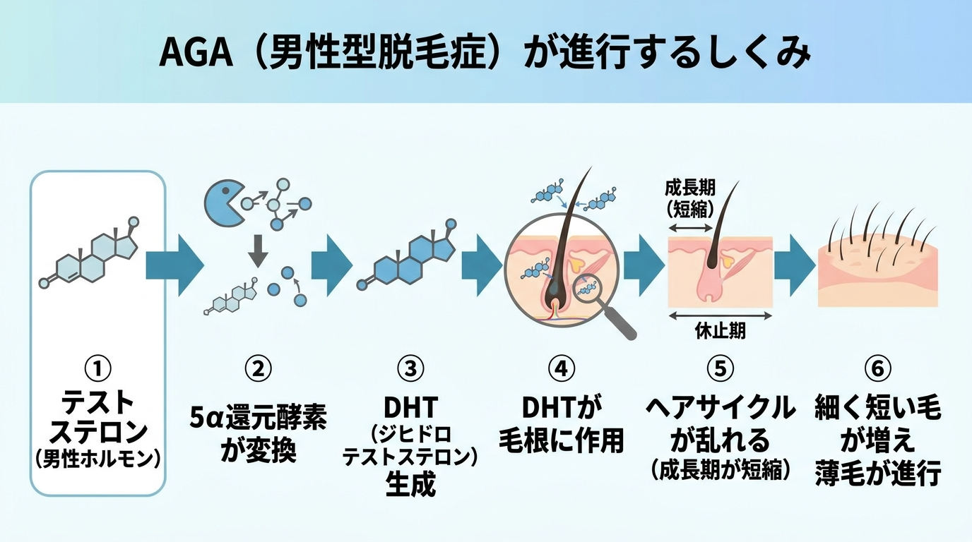 タイトル: AGA（男性型脱毛症）が進行するしくみ。フロー図で左から右へ: ①テストステロン（男性ホルモン）→ ②5α還元酵素が変換 → ③DHT（ジヒドロテストステロン）生成 → ④DHTが毛根に作用 → ⑤ヘアサイクルが乱れる（成長期が短縮）→ ⑥細く短い毛が増え薄毛が進行。各ステップを矢印でつなぐ