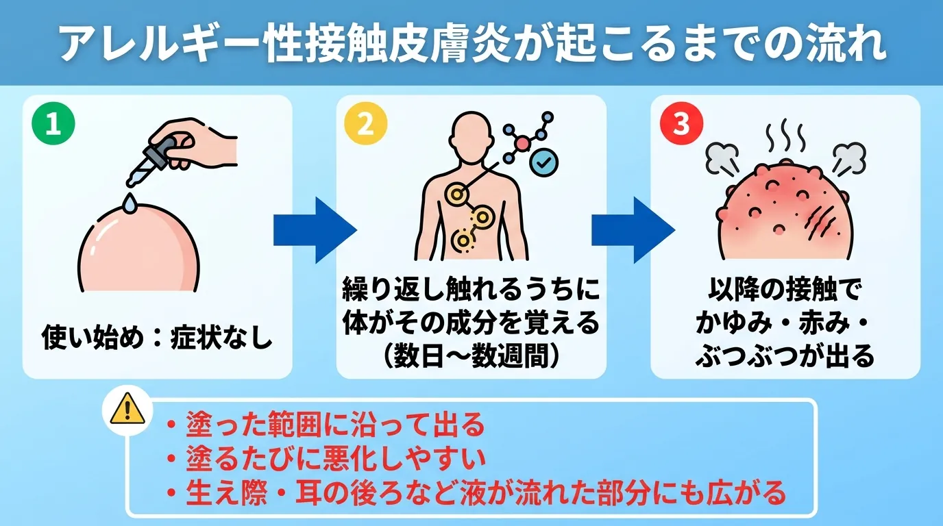 アレルギー性接触皮膚炎が起こるまでの流れ