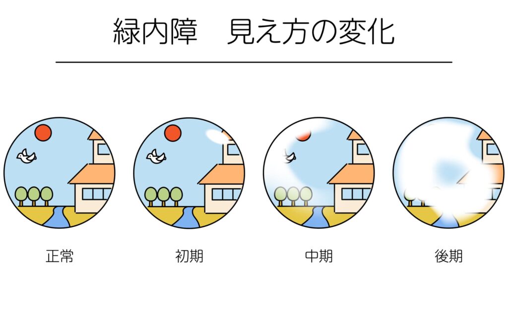 緑内障の見え方の変化