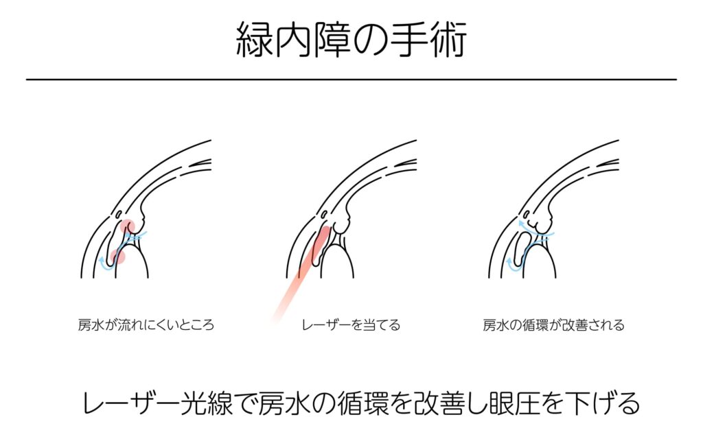 緑内障の手術