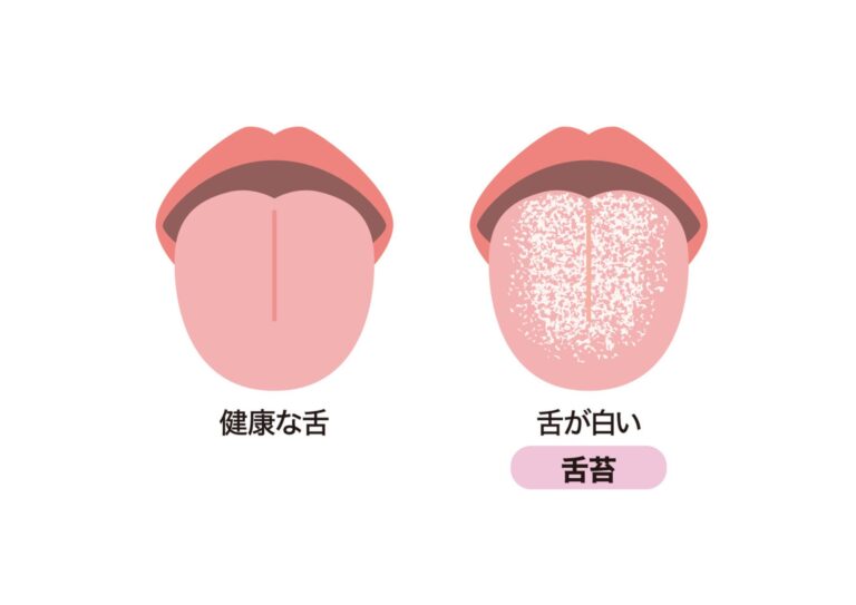 【医師監修】舌が白いのはなぜ？原因は舌苔か病気か｜見分け方・正しい取り方・受診の目安を歯科医が解説